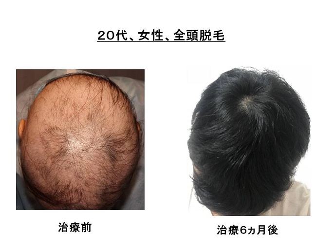 円形脱毛症　病院""